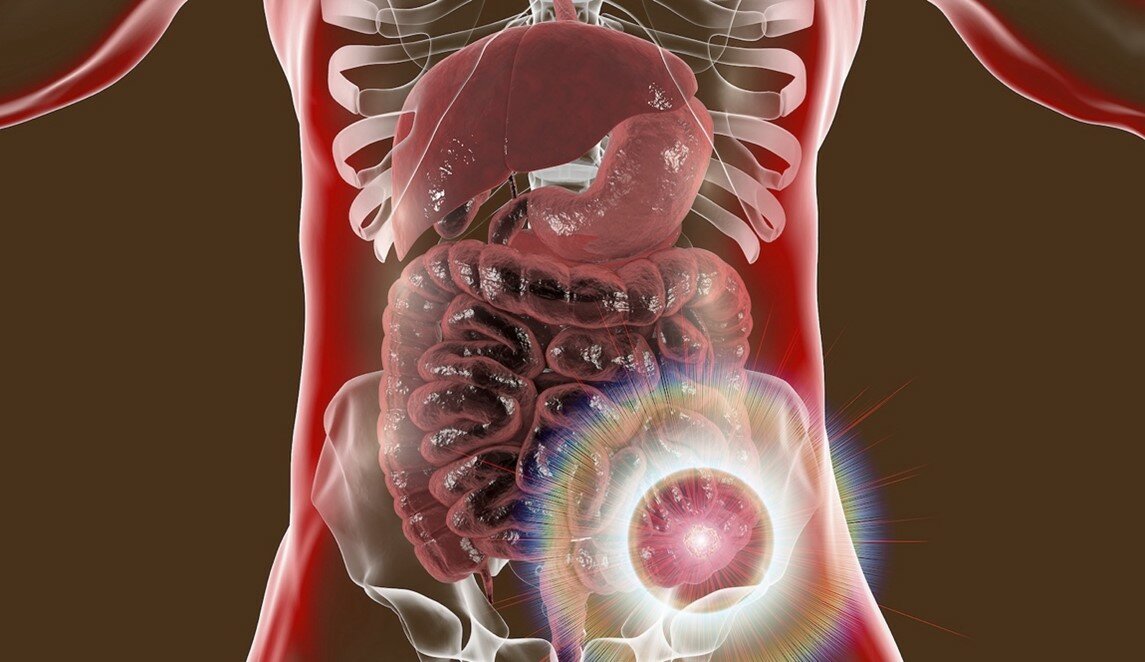 A healthy lifestyle can go a long way in limiting your risk factors. But no matter your risk level, it’s important to have regular screening for colorectal cancer.