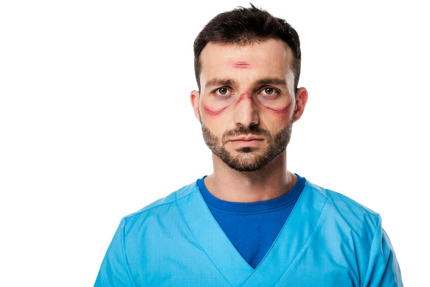 A male doctor with the cutting marks of goggles pressed into his face, looking exhausted and burnt out.