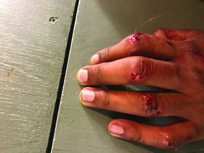 Police provided this photo of the left hand of Marcel D. Zulauf-Stewart. It shows hairs allegedly of the person Zulauf-Stewart was beating when police arrived on Aug. 26, 2021.