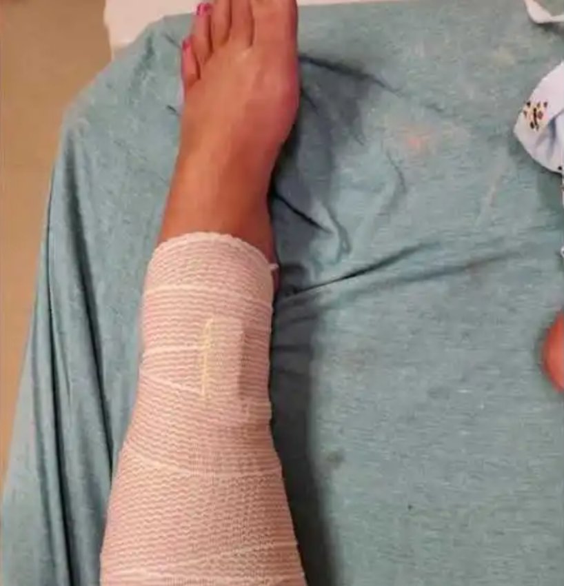 The woman's leg after it was treated.
